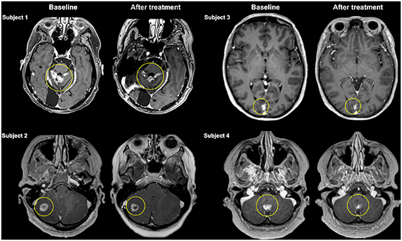 Ultrason beyindeki metastazın tedavisini sağladı - Resim: 1