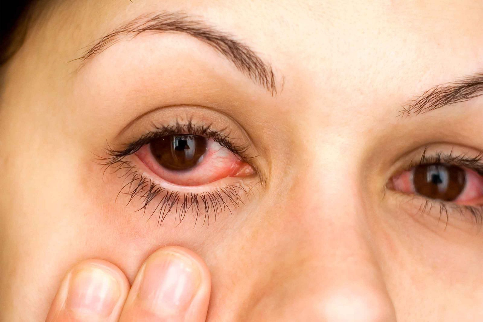Göz kanlanması neden olur? Göz kanlanması nasıl geçer? İşte iyi gelen